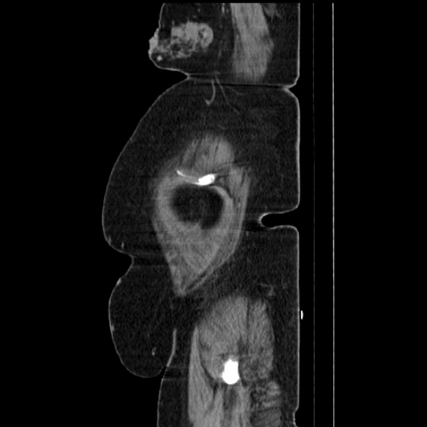 Acute pyelonephritis (Radiopaedia 25657-25837 Sagittal renal parenchymal phase 72).jpg