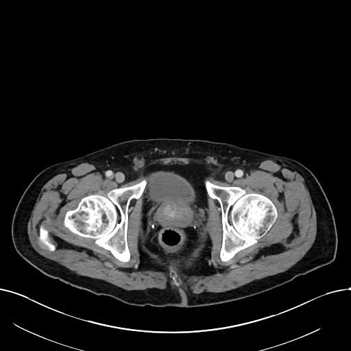 File:Acute renal infarction (Radiopaedia 59375-66736 Axial C+ portal venous phase 115).jpg
