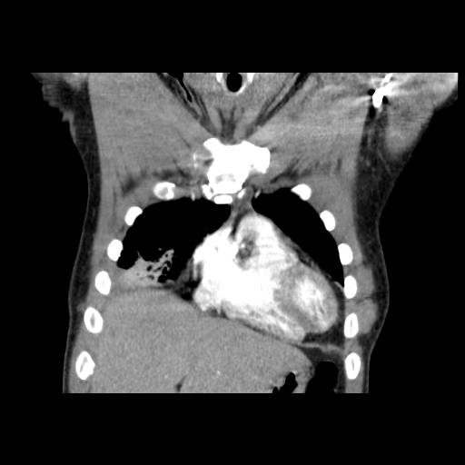 Acute segmental pulmonary emboli and pulmonary infarction (Radiopaedia 62264-70444 Coronal C+ CTPA 6).jpg