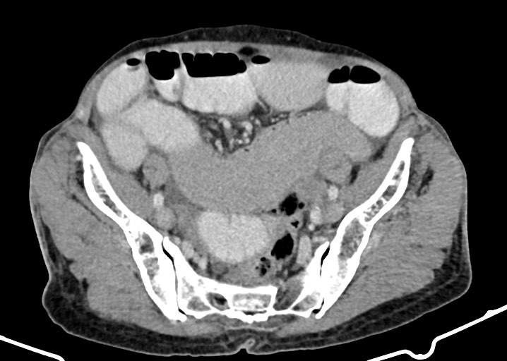Acute small bowel (ileal) volvulus (Radiopaedia 71740-82139 Axial C+ portal venous phase 156).jpg