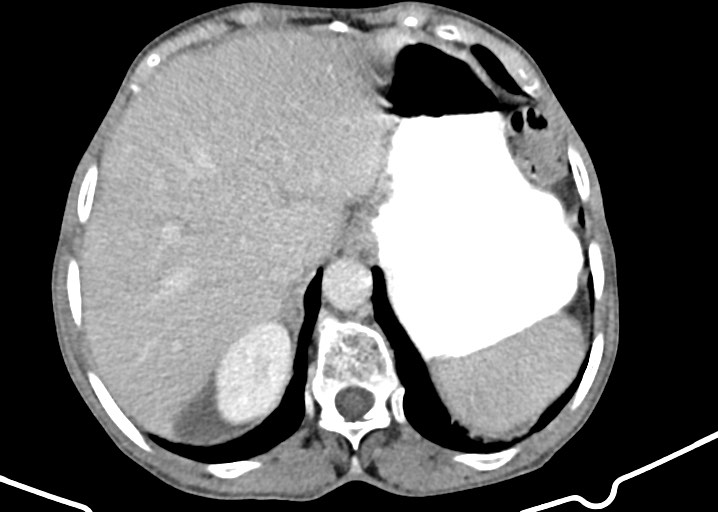 Acute small bowel (ileal) volvulus (Radiopaedia 71740-82139 Axial C+ portal venous phase 55).jpg