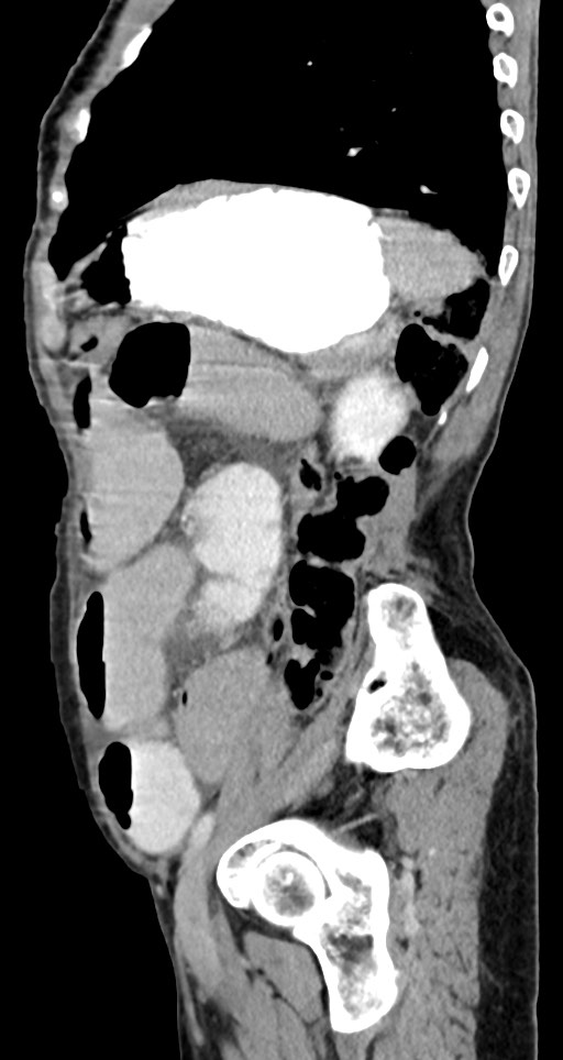 Acute small bowel (ileal) volvulus (Radiopaedia 71740-82139 Sagittal C+ portal venous phase 54).jpg