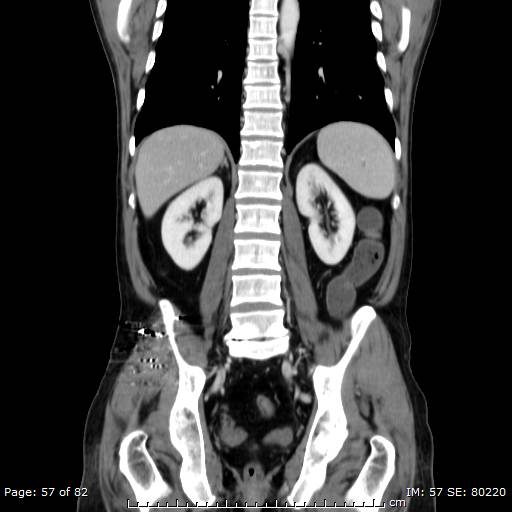 Acute superior mesenteric artery occlusion (Radiopaedia 43636-47060 Coronal C+ portal venous phase 42).jpg
