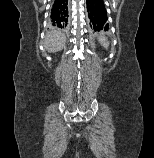 Acute superior mesenteric artery occlusion (Radiopaedia 51288-56960 Coronal C+ portal venous phase 64).jpg