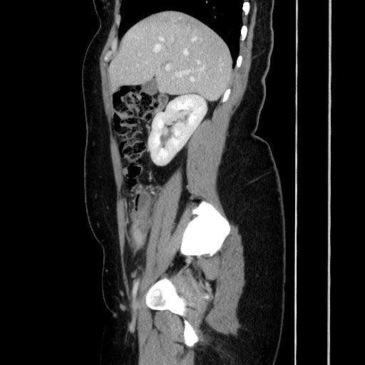 Acute uncomplicated appendicitis (Radiopaedia 73704-84499 Sagittal C+ portal venous phase 82).jpg