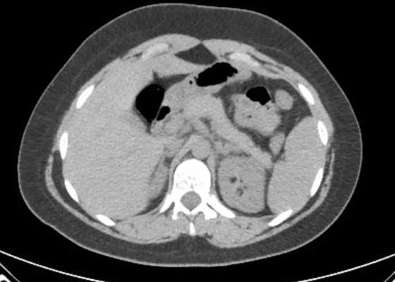 Acute unilateral nonhemorrhagic adrenal infarction (Radiopaedia 67560-76957 Axial non-contrast 33).jpg