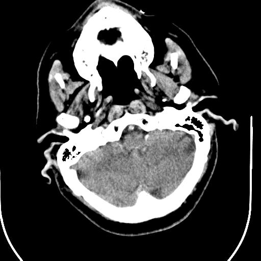 Acute vertebrobasilar ischemic infarction (Radiopaedia 25220-25473 Axial non-contrast 12).jpg