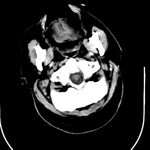 File:Acute vertebrobasilar ischemic infarction (Radiopaedia 25220-25473 Axial non-contrast 4).jpg
