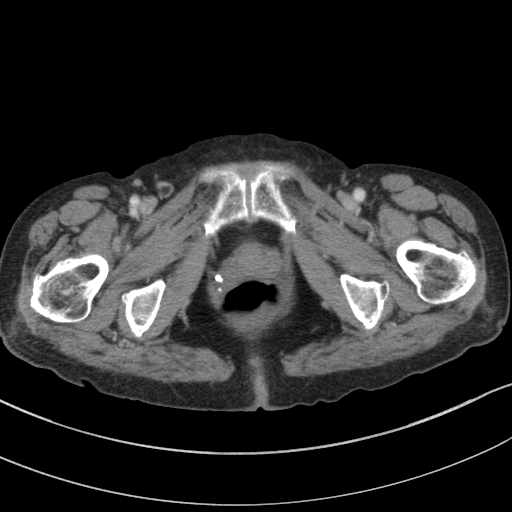 Adenocarcinoma of cecum (Radiopaedia 59222-66549 Axial C+ portal venous phase 162).jpg