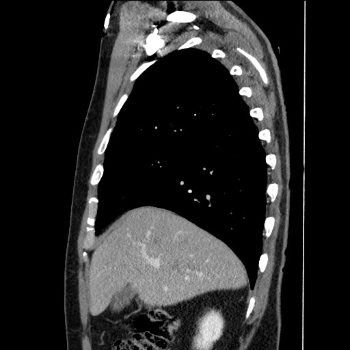 Adenocarcinoma of the lung (Radiopaedia 59871-67325 Sagittal C+ arterial phase 22).jpg