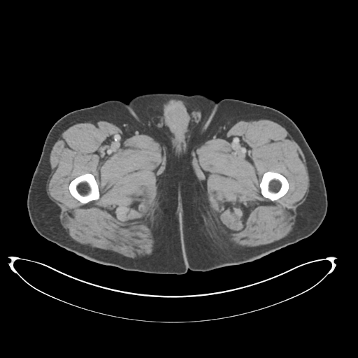 Adenocarcioma of rectum- T1 lesion (Radiopaedia 36921-38547 Axial C+ portal venous phase 101).png