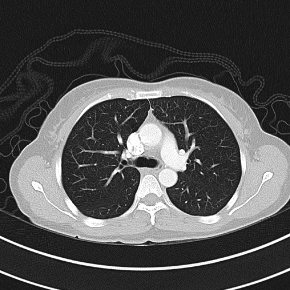 File:Adenocystic carcinoma of the trachea (Radiopaedia 47677-52525 Axial lung window 46).jpg