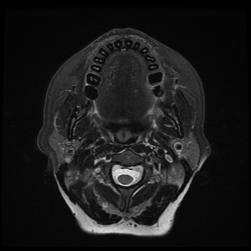 File:Adenoid cystic tumor of palate (Radiopaedia 46980-51519 Axial T2 fat sat 18).png