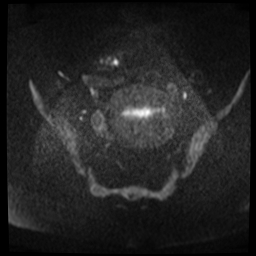 File:Adenomyosis-scar endometriosis (Radiopaedia 65863-75022 Axial DWI 4).jpg