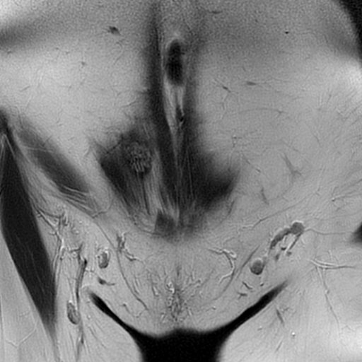 File:Adenomyosis-scar endometriosis (Radiopaedia 65863-75022 Coronal T2 3).jpg
