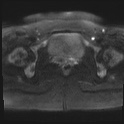 File:Adenomyosis and endometriotic cysts (Radiopaedia 82300-96367 Axial DWI 22).jpg