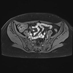 File:Adenomyosis and endometriotic cysts (Radiopaedia 82300-96367 Axial T1 C+ fat sat 24).jpg