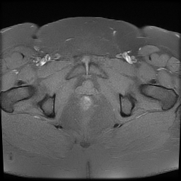 File:Adenomyosis within a didelphys uterus (Radiopaedia 70175-80215 Axial T1 fat sat 36).jpg