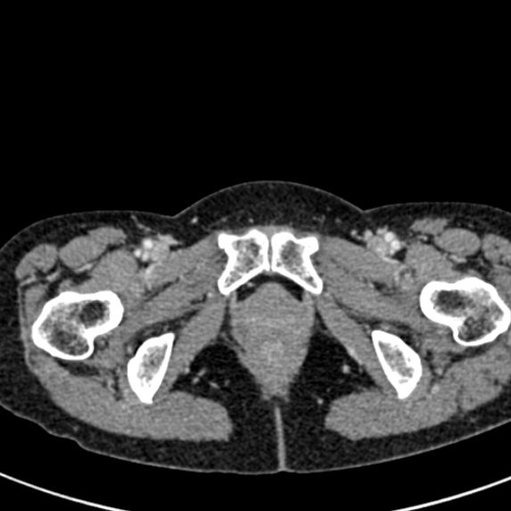 File:Adhesional small bowel obstruction (Radiopaedia 48397-53305 Axial C+ portal venous phase 96).jpg