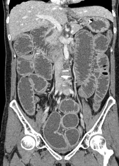 Adhesional small bowel obstruction (Radiopaedia 48397-53305 Coronal C+ portal venous phase 169).jpg