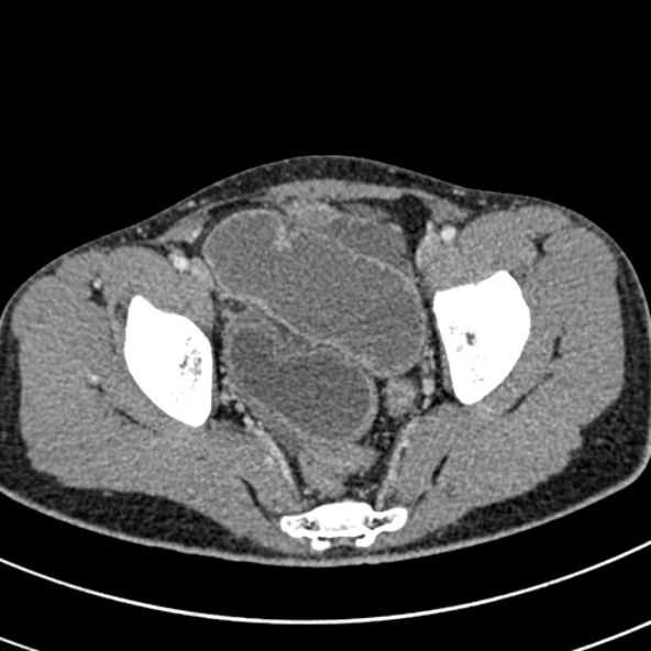 Adhesional small bowel obstruction (Radiopaedia 52107-57980 Axial C+ portal venous phase 113).jpg