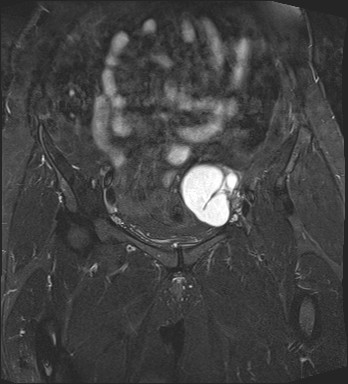 File:Adnexal multilocular cyst (O-RADS US 3- O-RADS MRI 3) (Radiopaedia 87426-103754 Coronal T2 fat sat 10).jpg