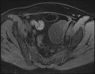 File:Adnexal multilocular cyst (O-RADS US 3. O-RADS MRI 3) (Radiopaedia 87426-103754 Axial 189).jpeg