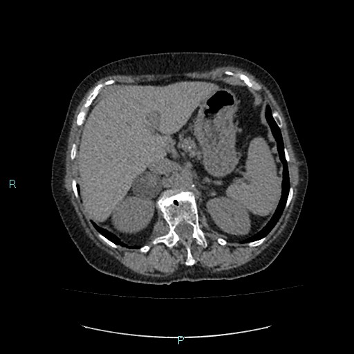 File:Adrenal collision tumor (ACT) (Radiopaedia 48462-53379 Axial non-contrast 14).jpg