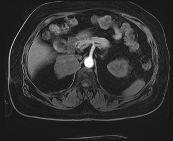 Adrenal cortical carcinoma (Radiopaedia 64017-72770 H 12).jpg