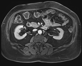 Adrenal cortical carcinoma (Radiopaedia 64017-72770 K 46).jpg