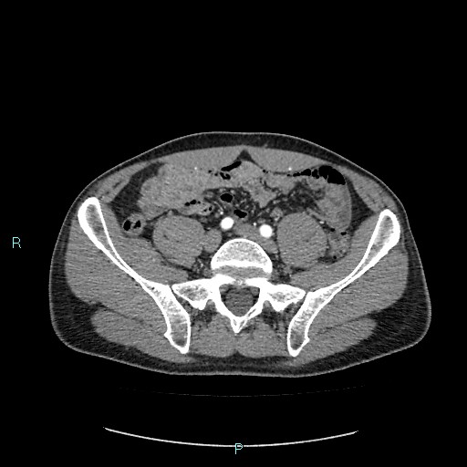 Adrenal cystic lymphangioma (Radiopaedia 83161-97534 Axial C+ arterial phase 69).jpg