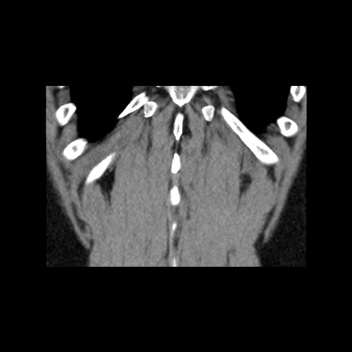 Adrenal gland trauma (Radiopaedia 81351-95079 Coronal non-contrast 80).jpg