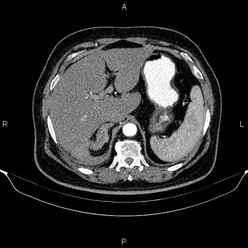 Adrenal hemorrhage (Radiopaedia 62622-70916 Axial C+ arterial phase 77).jpg