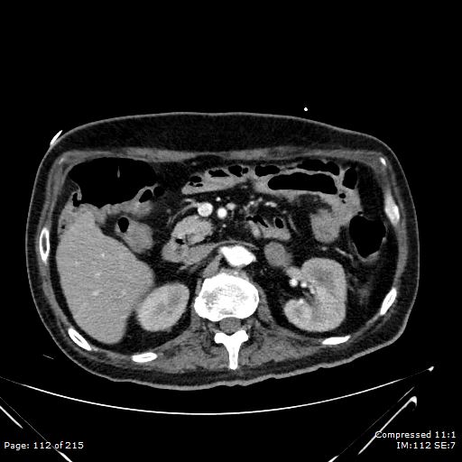 Adrenal metastasis (Radiopaedia 78425-91079 Axial C+ arterial phase 42).jpg