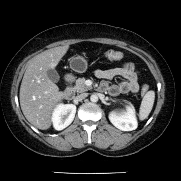 Adrenal myelolipoma (Radiopaedia 43401-46759 Axial C+ portal venous phase 31).jpg
