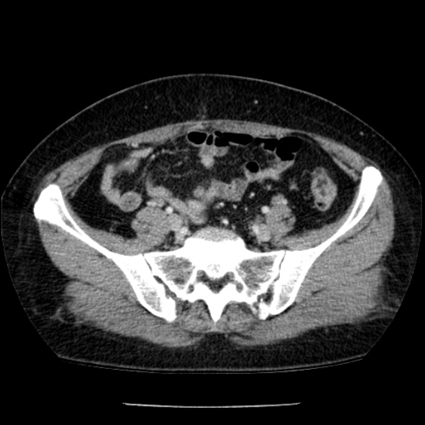 Adrenal myelolipoma (Radiopaedia 43401-46759 Axial C+ portal venous phase 66).jpg