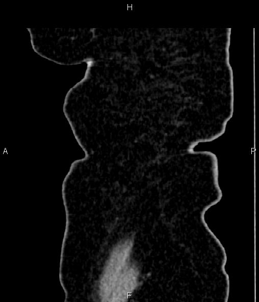 Adrenal myelolipoma (Radiopaedia 82742-96986 Sagittal renal cortical phase 105).jpg