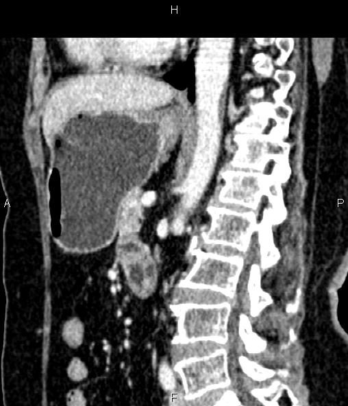 File:Adrenal myelolipoma (Radiopaedia 82742-96986 Sagittal renal cortical phase 62).jpg
