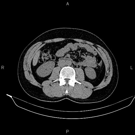 Adrenal myelolipoma (Radiopaedia 87794-104246 Axial non-contrast 54).jpg
