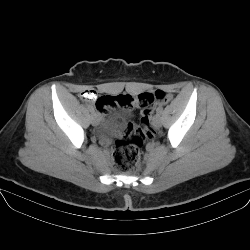 File:Adrenal myelolipoma - bilateral (Radiopaedia 74805-85810 Axial non-contrast 70).jpg