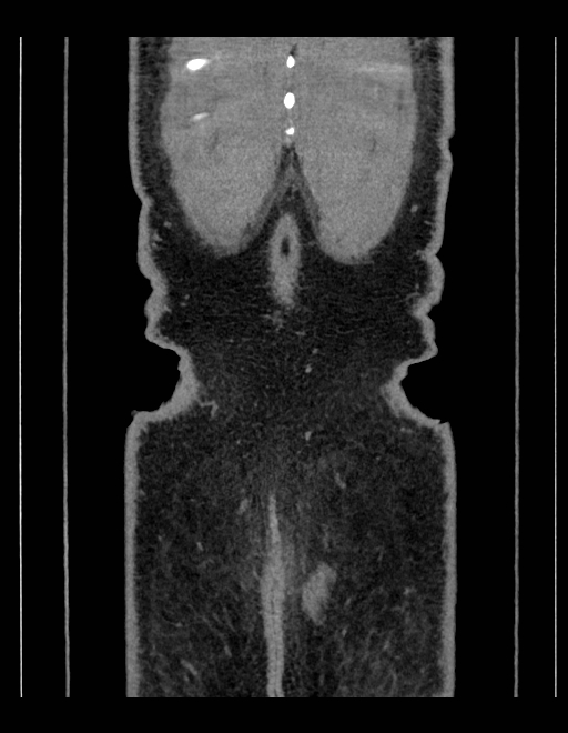 Adrenal myelolipoma - bilateral (Radiopaedia 74805-85810 Coronal C+ portal venous phase 40).jpg