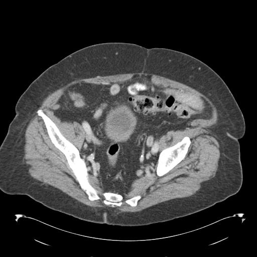 Adult ileal intussusception with secondary obstruction (Radiopaedia 30395-31051 Axial C+ portal venous phase 64).jpg