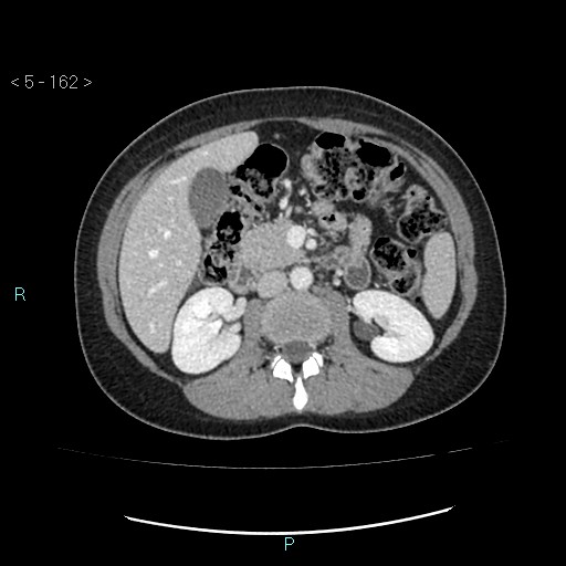 File:Adult transient intestinal intussusception (Radiopaedia 34853-36310 Axial C+ portal venous phase 23).jpg