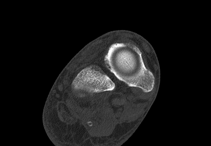 Advanced osteomyelitis due to open metatarsal fracture (Radiopaedia 83891-99095 Axial bone window 17).jpg