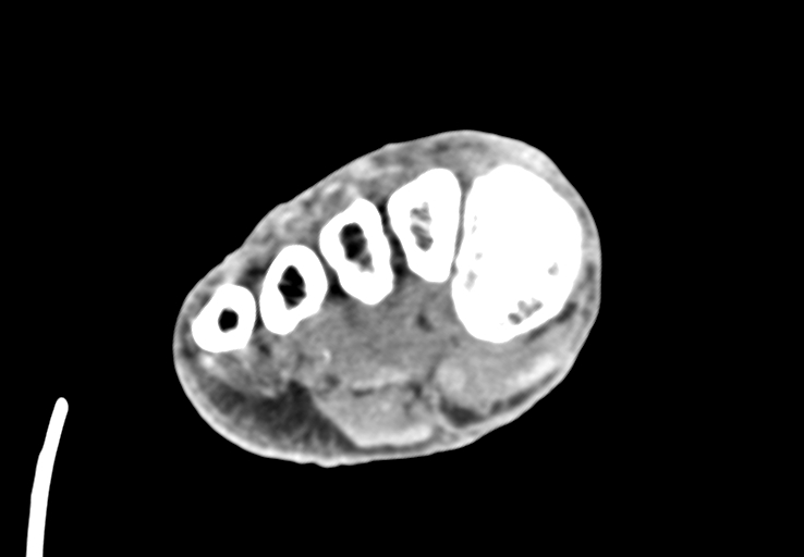 File:Advanced osteomyelitis due to open metatarsal fracture (Radiopaedia 83891-99095 Axial non-contrast 29).jpg