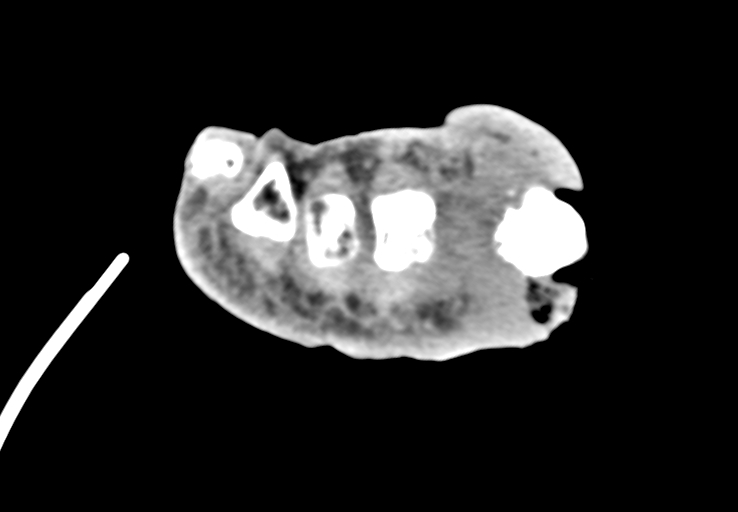 Advanced osteomyelitis due to open metatarsal fracture (Radiopaedia 83891-99095 Axial non-contrast 44).jpg