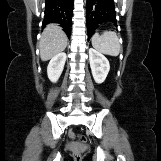 File:Afferent loop syndrome - secondary to incarcerated trocar site hernia (Radiopaedia 82959-97305 Coronal C+ portal venous phase 107).jpg
