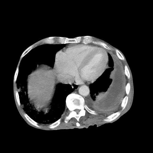 Aggressive lung cancer with cardiac metastases, pulmonary artery tumor thrombus, and Budd-Chiari (Radiopaedia 60320-67981 A 43).jpg