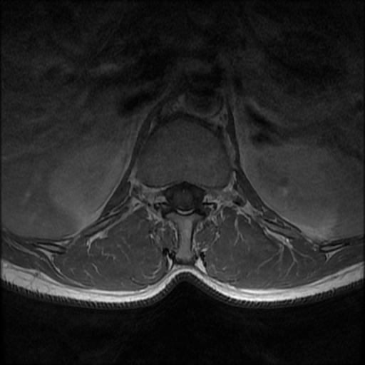 File:Aggressive vertebral hemangioma with pathological fracture (Radiopaedia 69528-79411 Axial T1 C+ 16).jpg