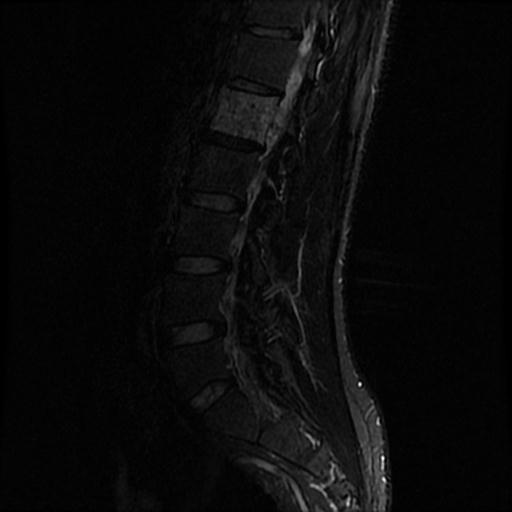 File:Aggressive vertebral hemangioma with pathological fracture (Radiopaedia 69528-79411 Sagittal STIR 7).jpg